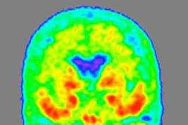 神经元 带你深入了解——阿尔茨海默病
