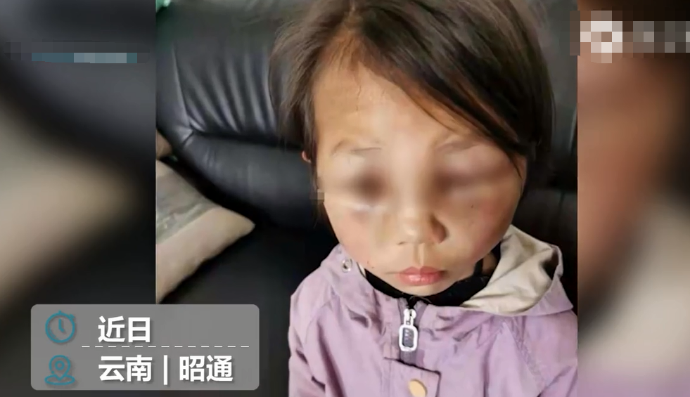 视野新闻周刊 云南女童疑遭继母虐打，生父称无能为力自己也很受气，继母因怀孕未被采取强制措施