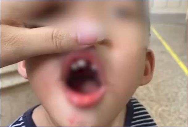 四面观察 幼儿园女老师推搡男童致其门牙脱落，涉事老师被控制，幼儿园关停