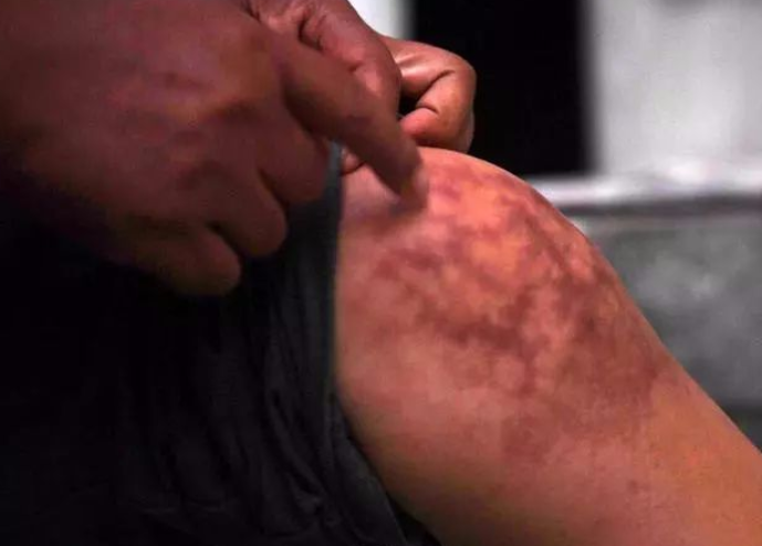 医学小栈|77岁老汉摔倒住院，查出滑膜炎，医生：双脚早有预示，是他没在意