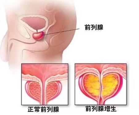 好事多为|怎样诊断与治疗淋菌性前列腺炎