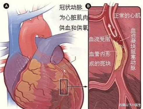 石佛山下小医生|急性心肌梗死是怎么引起的，严重会怎么样？