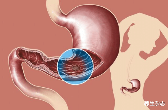 火锅|1“火锅”或是胃癌“触发器”,医生:吃一口等于8斤塑料,趁早戒
