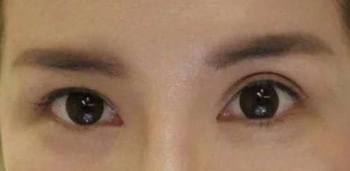 医生|为什么我的眼睛反复修了很多次,还是不好看呢?