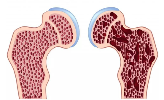 南湖御|多走路能预防骨质疏松吗？医生：2种食物少吃，或比走路更重要