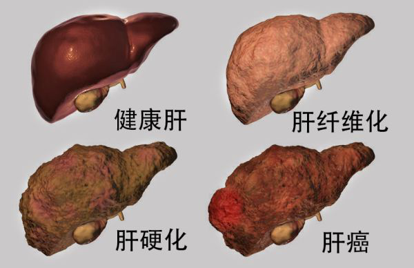 医线天|27岁男子肝癌晚期，化疗3次身亡，医生怒吼：2种食物怎能天天吃