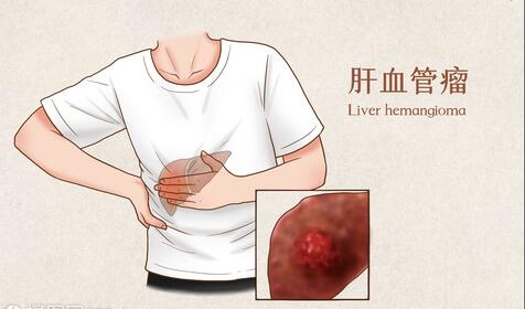 顺能健康体检 体检发现肝血管瘤，该怎么办？