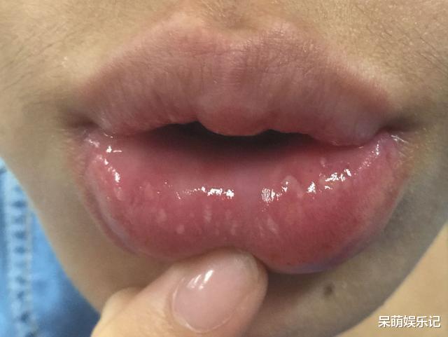 排毒|嘴上长泡是身体在排毒吗？或许是暗示了这几个问题，别忽视