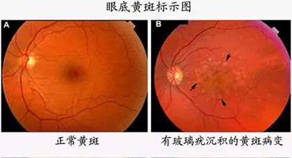 广元EYE小霸王|黄斑病变的常见类型