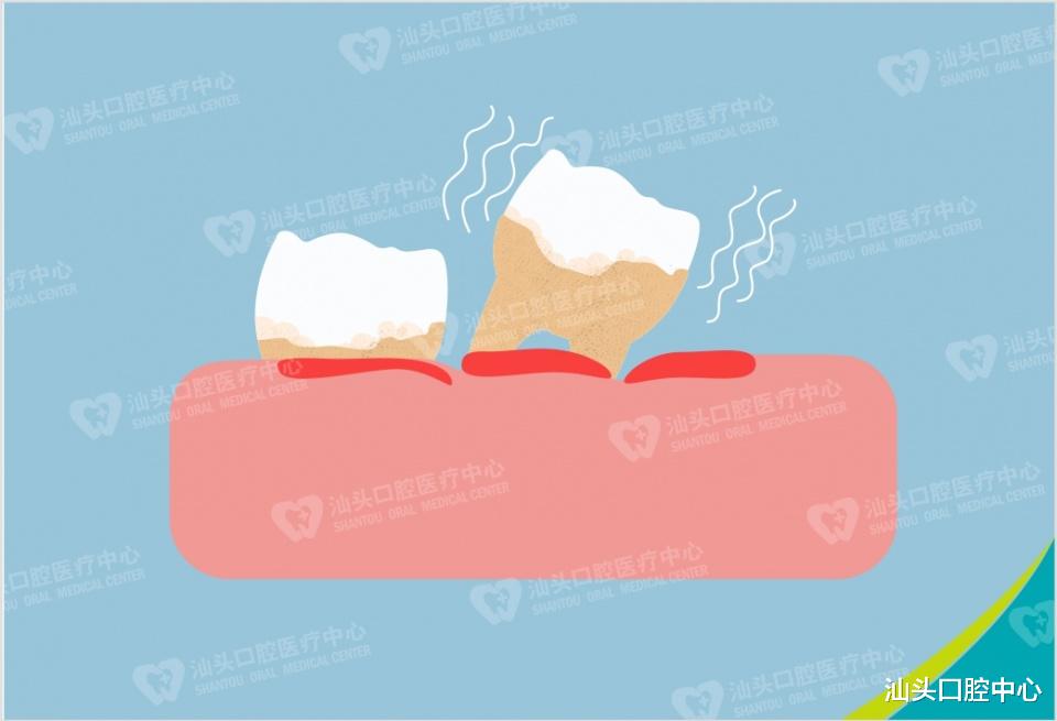 汕头口腔中心|牙齿松动了该怎么办呢？这几点帮助你处理牙齿松动问题