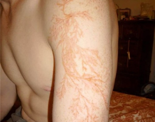 雕刻 被雷劈后身上出现恐怖闪电疤痕，这可比哈利波特的酷多了