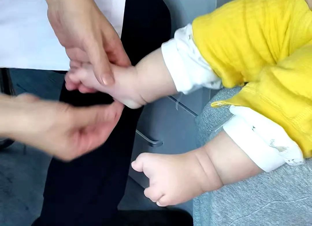 协和手足外科陈江海 “30岁怀孕，孕6个月时发现宝宝脚有问题。”妈妈说着说着就哭了