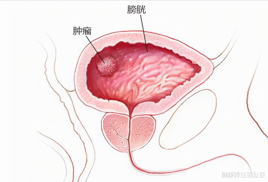 健康养生百分百 无痛血尿可能是膀胱癌的唯一表现，有这个习惯的男性，最好检查下