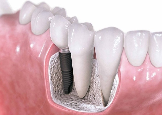 一口假牙能换一辆宝马，被贴暴利标签的种植牙，为何会如此贵？