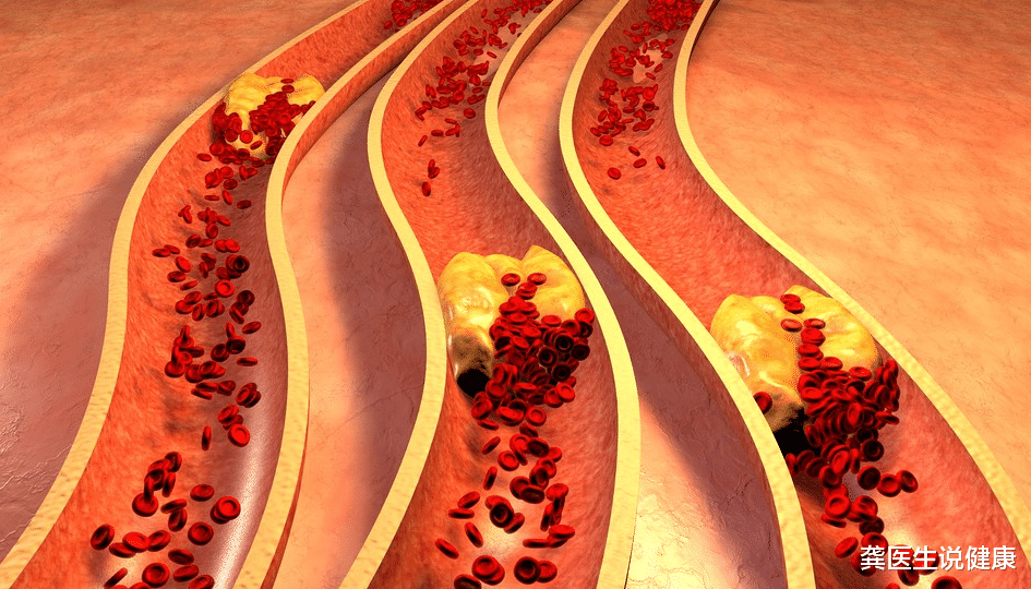 龚医生说健康 血栓的形成非朝夕,避免生活中的“2怕和3忌”,血管或可通透无阻