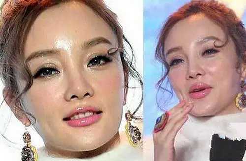 整容|整容失败的10位明星，谁堪称“阴影”之最？