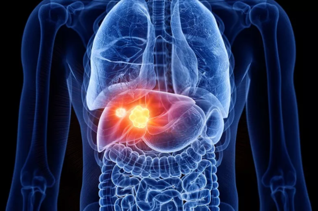 芊影健康|芊影：我国乙肝病毒感染者高达7000万！消除肝炎，时不我待