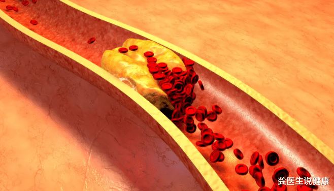 龚医生说健康|高血脂只需吃药就能控制？提醒：这3种食物不忌口，吃再多药也白搭