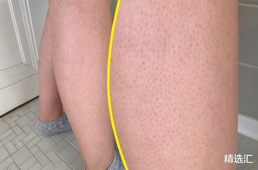 亚硝酸盐|被很多女性视为缺陷,但实属正常情况的7个外观特点