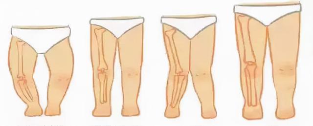 中康之家 怎么判断孩子是O、X型腿？