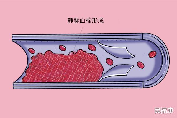 静脉血栓|摔倒后双腿肿胀，竟引起了下肢静脉血栓？该如何预防？
