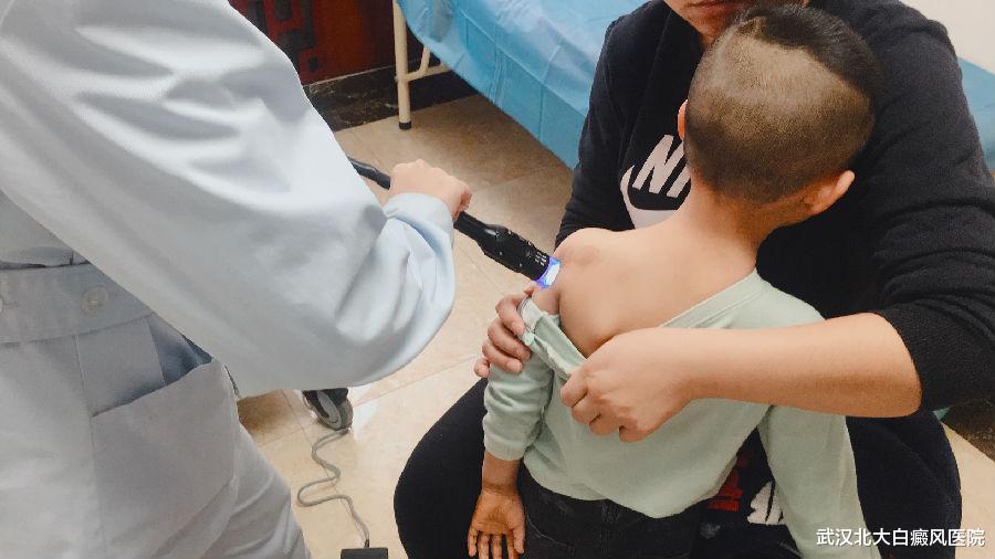 武汉北大白癜风医院|光疗治疗白癜风，这5大因素影响着光疗效果！