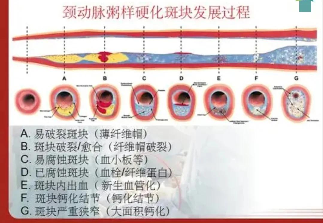 牙龈萎缩|坚持7年，颈动脉斑块“消失”，4种方法“护血管”，真的可以做到。