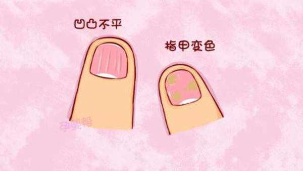 健康养生冲我作|引起灰指甲的4个原因，三个预防方法，让你远离灰指甲