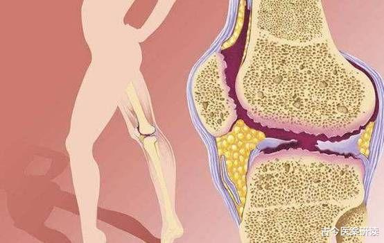 经络|经常跑步跑出了滑膜炎?医生:3个小妙招,或能助你轻松防治滑膜炎