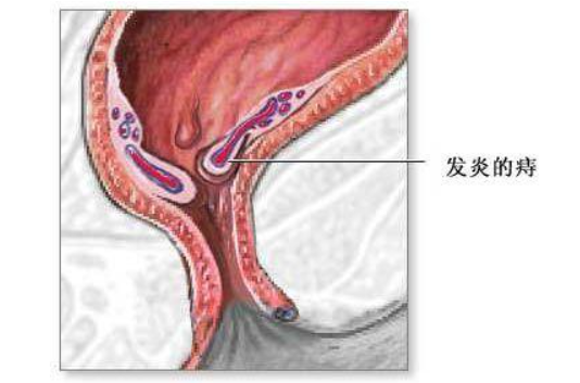 牡丹晚报 菏泽中医院专家解读:痔疮的科学诊疗与预防