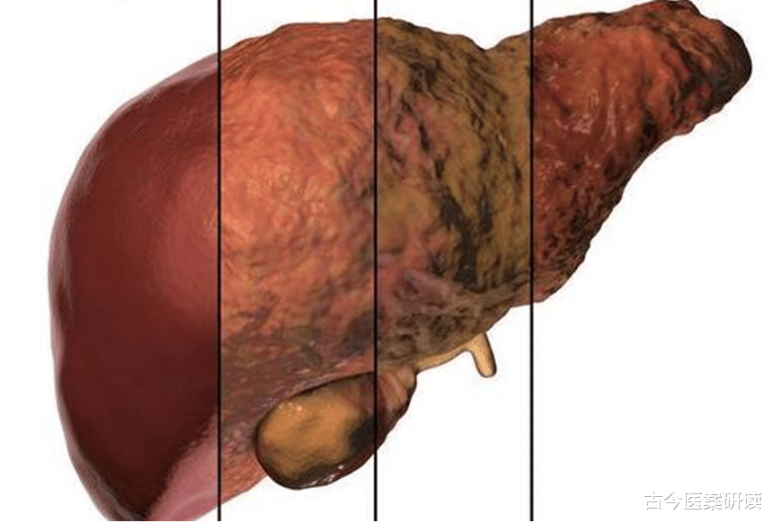 肝脏|近几年肝癌多发；医生提示：身上这2处疼，千万别大意，多半是肝受损了