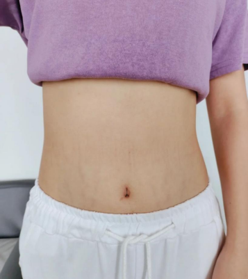 碗盆妈咪|产后宝妈的淡化妊娠纹“三部曲”，用上这3招，花肚皮远离你！