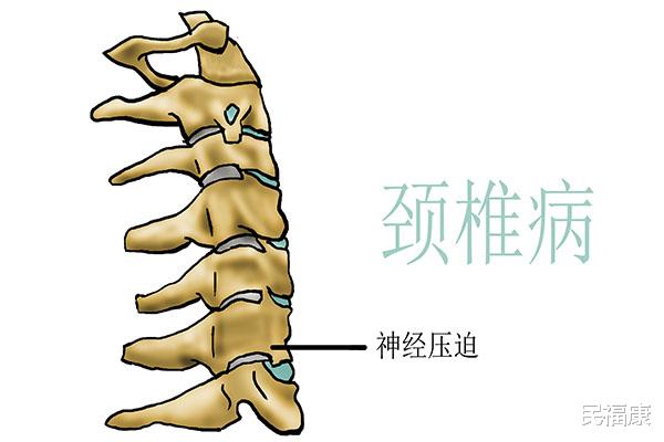 颈椎病|34岁的年纪60岁的颈椎，破防了，4个动作易伤颈椎，有些人天天做