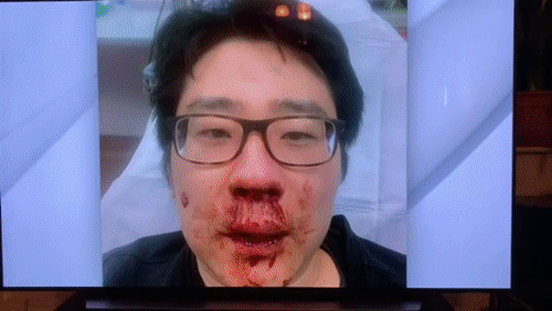 中國留學生被白人暴打：除扇耳光還用玻璃砸頭，中方第一時間表態-圖2