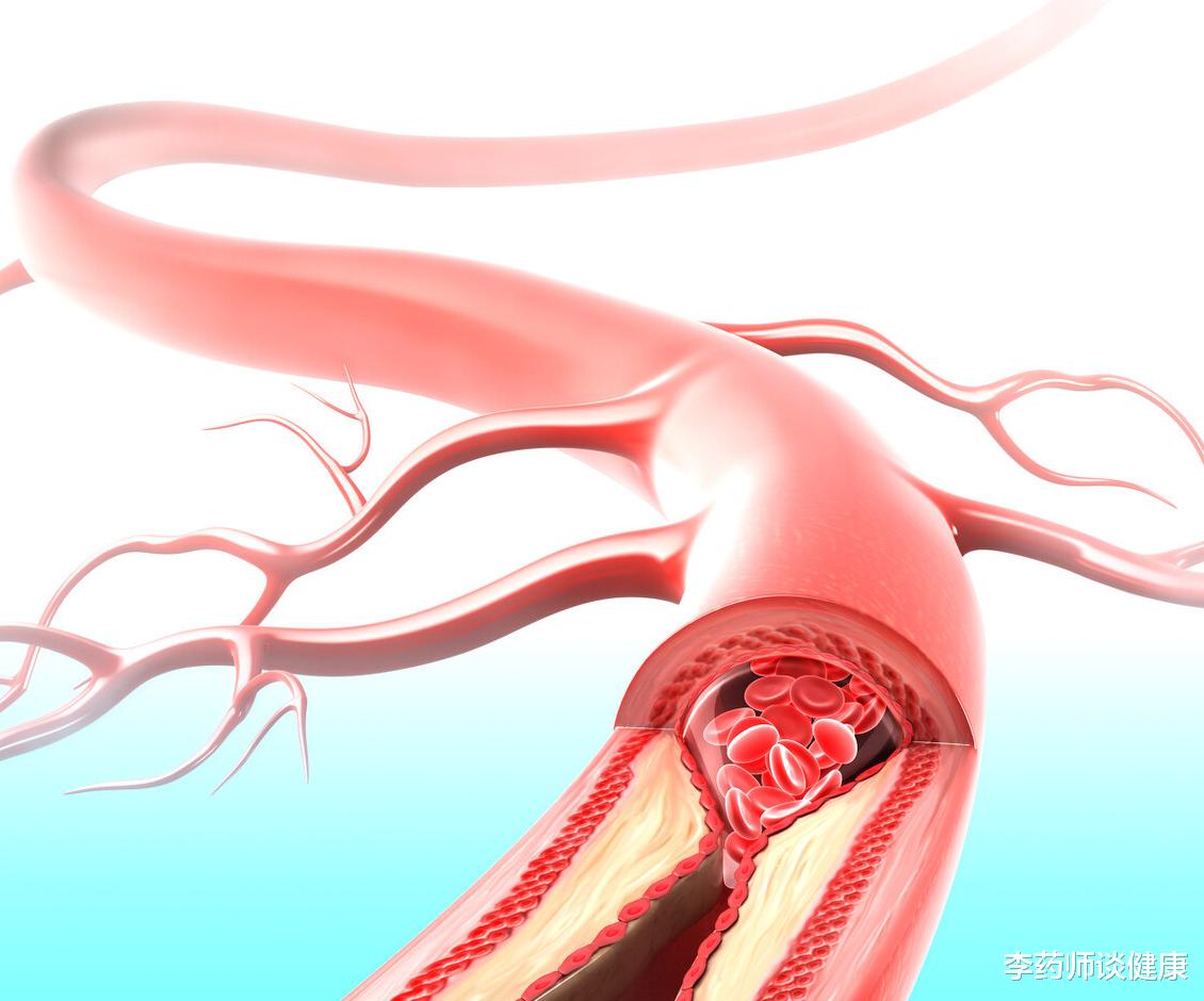 高血脂|高血脂颈动脉斑块，坚持吃鱼油1年，血管软化了吗？检查结果来了
