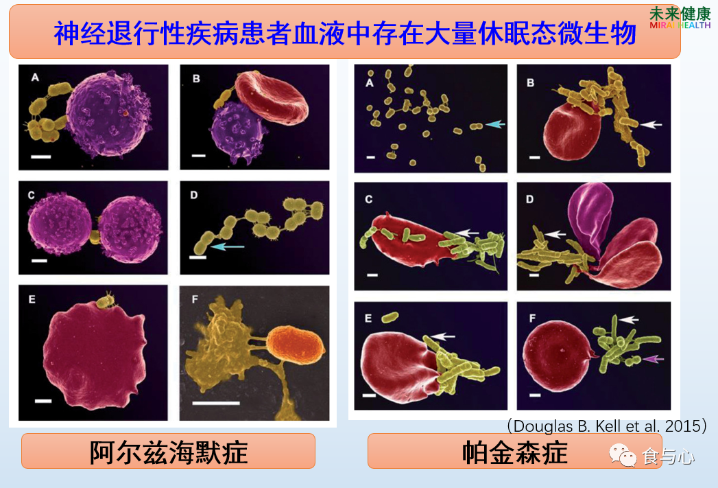 益生菌|补充益生菌能改善帕金森症吗？最新科研结果给出肯定回答