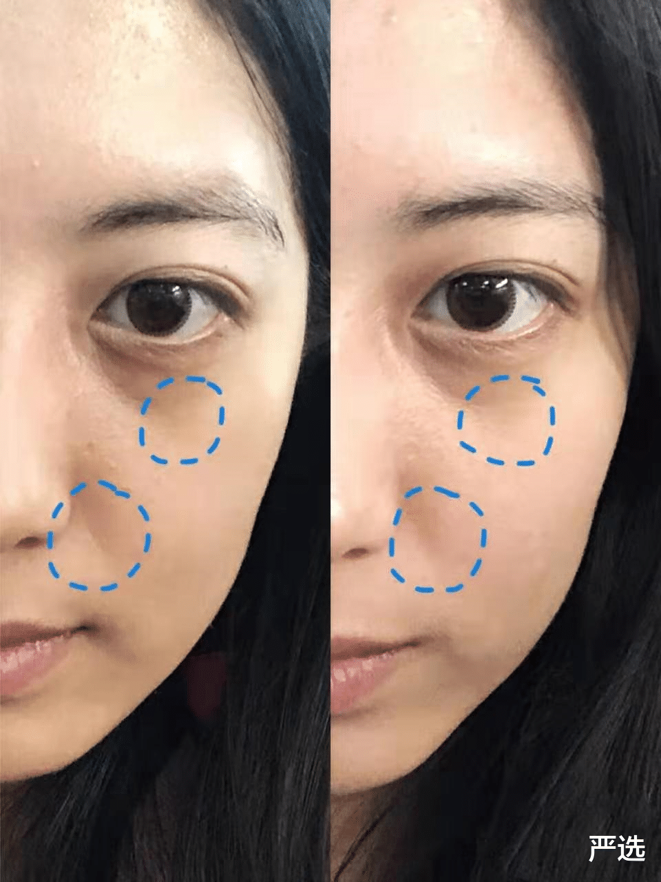 整容|球球整容前后对比，看着皮肤细腻状态好，终于摆脱“鞋拔子”脸了