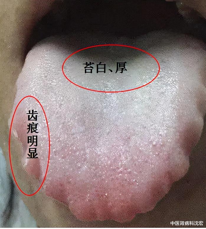 肠胃|齿痕舌，脾虚湿盛的标志？送你四味药食同源的中药，长期坚持消齿印