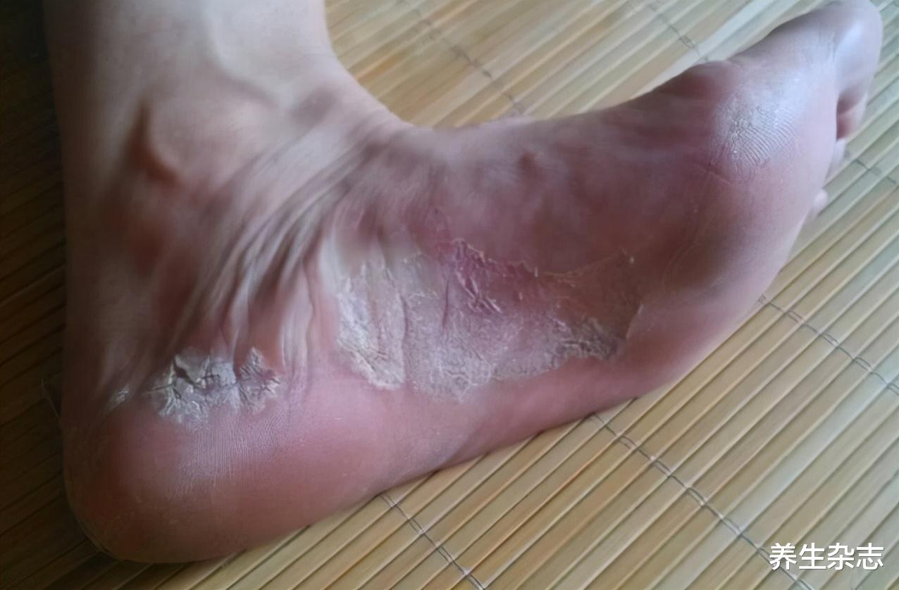 肝脏|转告家人：脚上若有4个异常，肝可能已经受损，劝你早查肝功能