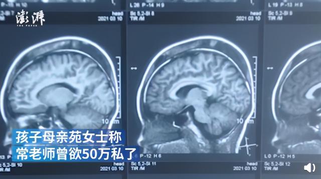 太平洋亲子网 9岁男孩被老师揪头发致皮骨分离，穿刺7次！但更令人后怕的是...