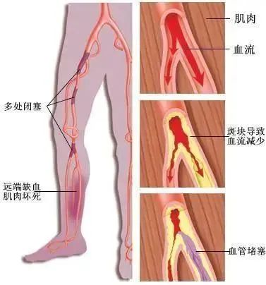 伴客未来 腿部出现这种症状，有可能是下肢“中风”！