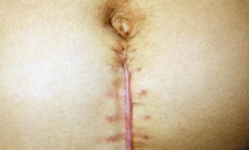 运动|剖腹产是美容线好还是普通线好？区别有3点，产妇早知道早预防