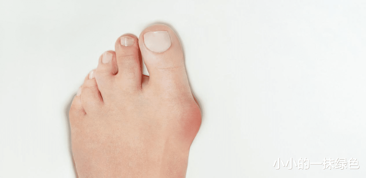 尿酸|?吃豆角会伤肾?肾脏科医生:不想肾“溃烂”,“3物”劝你少碰