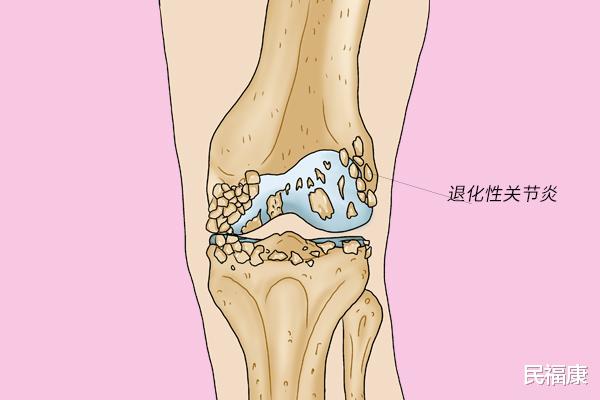 民福康|为什么老年人常出现骨关节问题？关节僵硬、疼痛、肿胀，怎么调理？