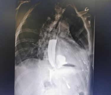 医院|酒醉呕吐能有好凶险嘛？没得好凶，也就是把食管吐破裂而已…v