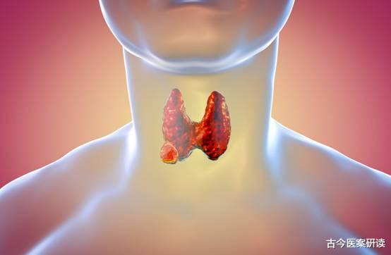 甲状腺癌|夫妻双双查出甲状腺癌，医生提醒：这道菜是“元凶”，很多人爱吃