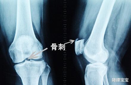 失眠|膝盖长了“骨刺”怎么办？必须除之而后快？