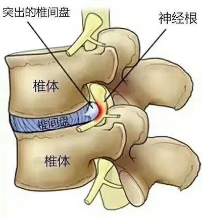 小杰啊啊 腰椎间盘突出症的根源在于筋，而不是骨头