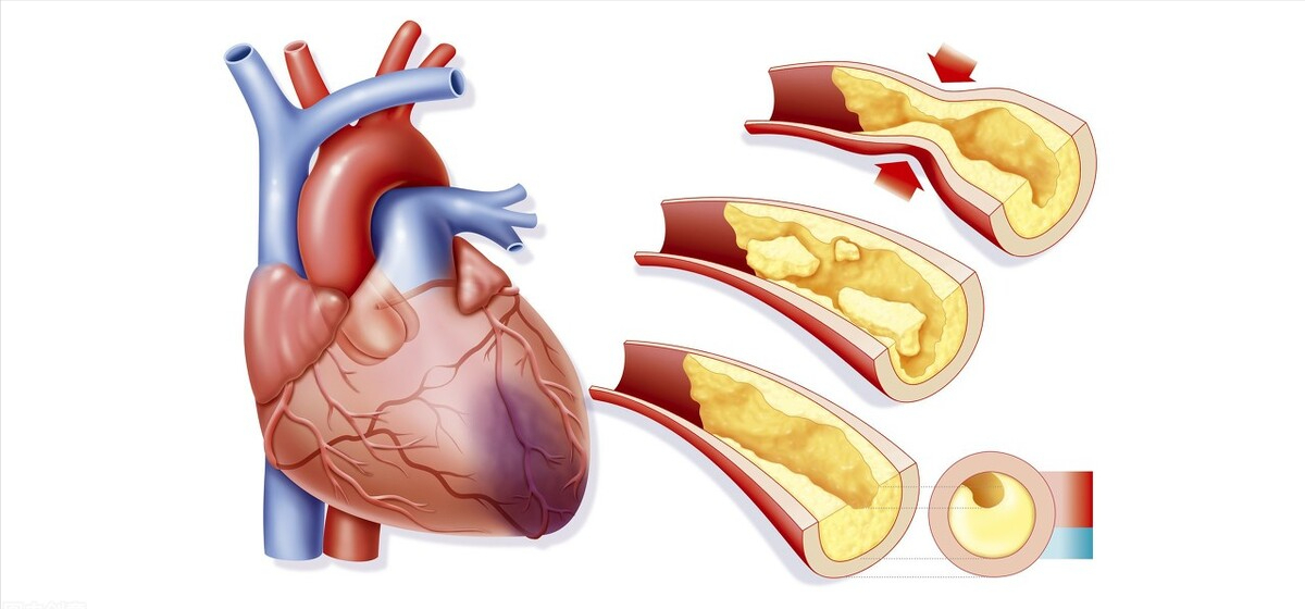 何药师健康科普 冠心病心绞痛,根在血脉不通,2个成药理气活血化瘀,保护心血管