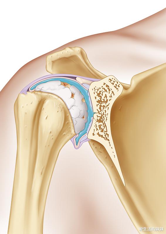 爱生活的妹妹|关于骨关节炎你需要知道的一切